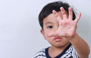 Funded Children’s Skin Infection Treatment