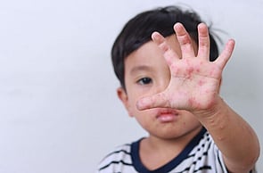 Funded Children’s Skin Infection Treatment